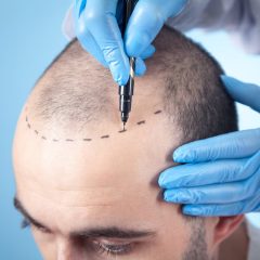What Causes Hair Loss and How Can It Be Prevented?
